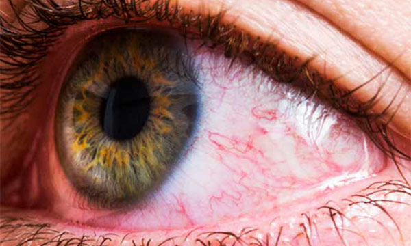 आंखो से सम्बन्धी डायबिटीज 