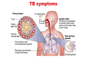 TB symptoms