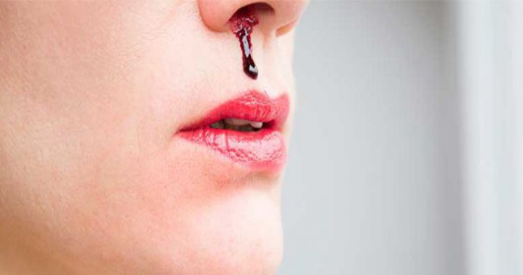 नकसीर के कारण और उपचार – Causes and Treatment Of Nosebleed