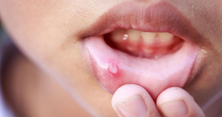 मुंह के छालो से छुटकारा पाने का घरेलु इलाज एवं मुंह के छालो  के कारण