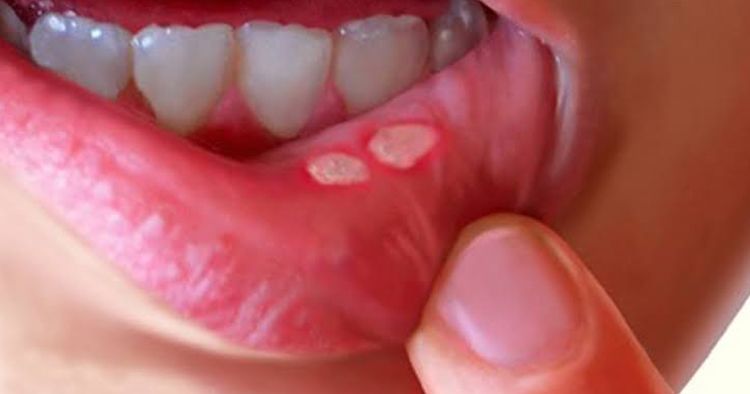 मुंह के छाले से बचाव का घरेलु उपाय – Mouth Ulcer Home Remedy In Hindi